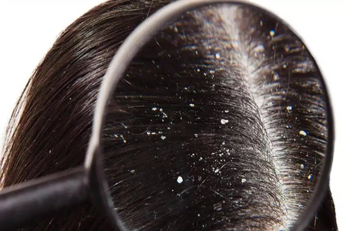 The Mystery of the Biggest Dandruff Flake Ever: 10 Home Remedies ...