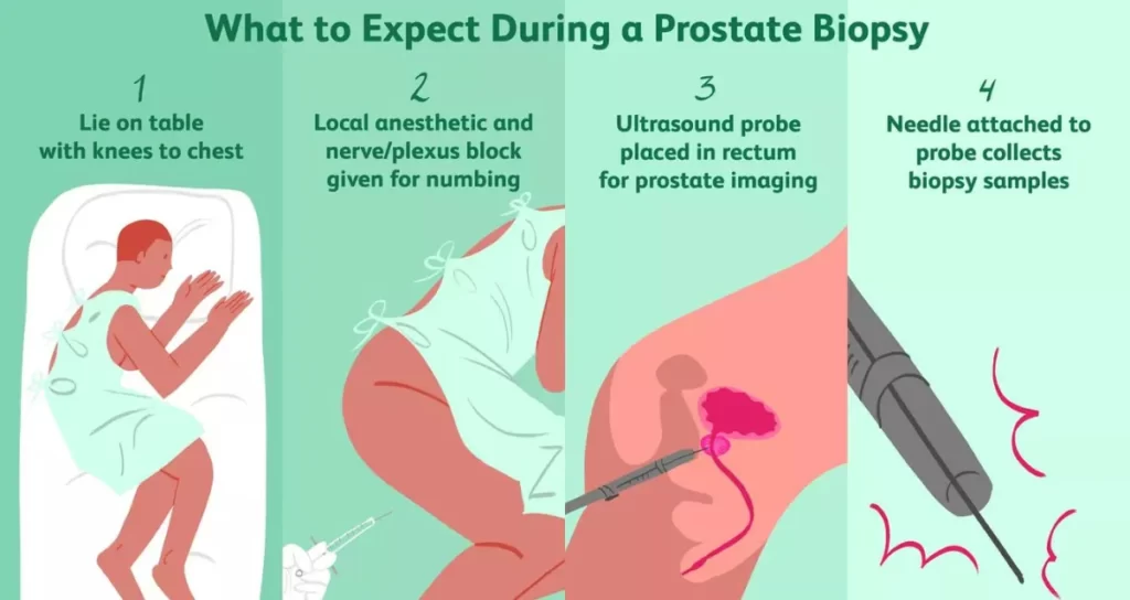 Transperineal prostate biopsy Side Effects and Risks
