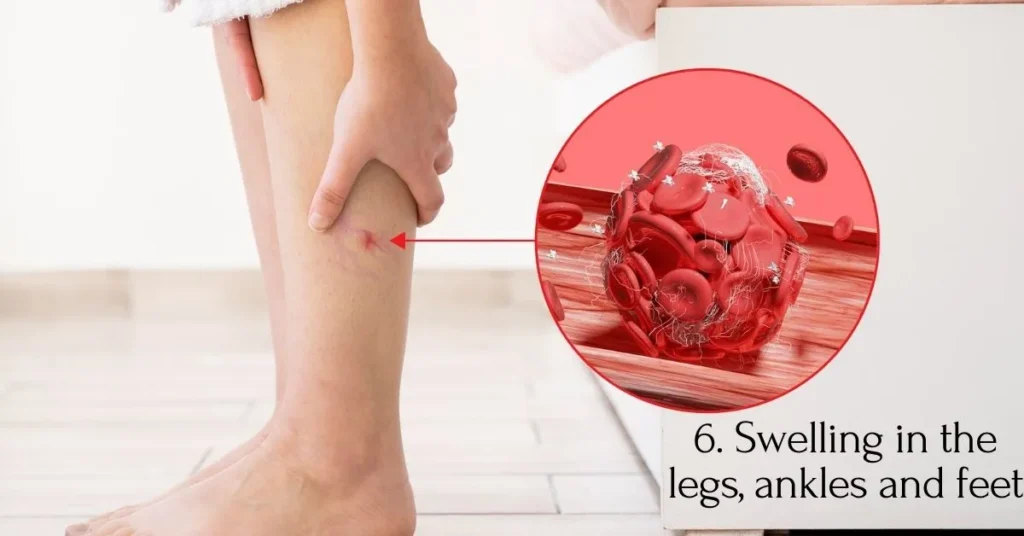 Swelling in the Legs, Ankles, and Feet: Unraveling the Significance in Cardiovascular Health