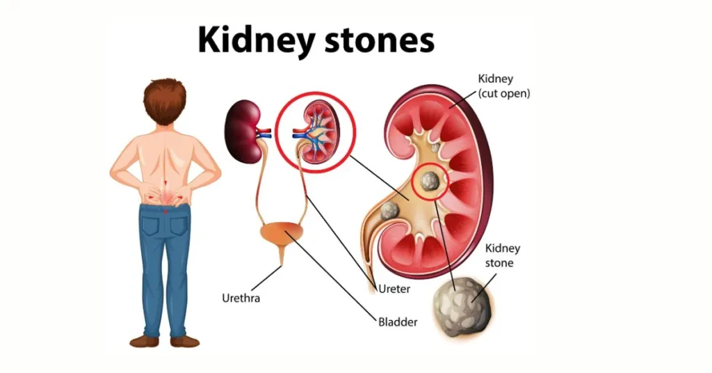 7-Day Kidney Stone Diet Chart